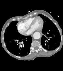 Aortic Aneurysm Erodes the Spine. Also Mucus Plugging Right Lower Lobe - CTisus CT Scan