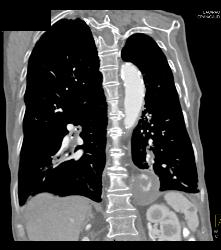 Aortic Aneurysm Erodes the Spine. Also Mucus Plugging Right Lower Lobe - CTisus CT Scan