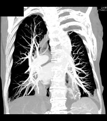 Aortic Aneurysm Erodes the Spine. Also Mucus Plugging Right Lower Lobe - CTisus CT Scan