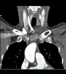 Left Parathyroid Adenoma - CTisus CT Scan