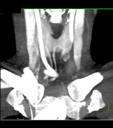 Left Parathyroid Adenoma - CTisus CT Scan