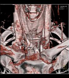 Beautiful 3D of Left Parathyroid Adenoma - CTisus CT Scan