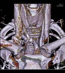 Beautiful 3D of Left Parathyroid Adenoma - CTisus CT Scan