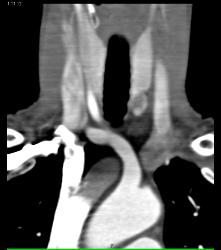 Beautiful 3D of Left Parathyroid Adenoma - CTisus CT Scan