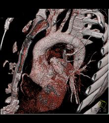 Dilated Aortic Root - CTisus CT Scan