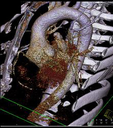 Dilated Aortic Root - CTisus CT Scan