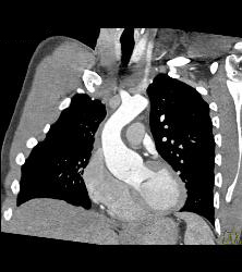 Dilated Aortic Root - CTisus CT Scan