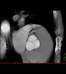 Dilated Aortic Root - CTisus CT Scan