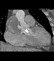 Pseudoaneurysm Off Aortic Root in Patient Post Surgical Repair of Root and Aortic Valve Replacement (AVR) - CTisus CT Scan