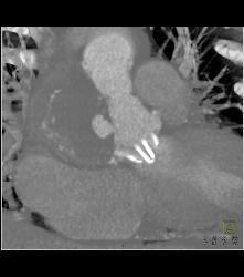 Pseudoaneurysm Off Aortic Root in Patient Post Surgical Repair of Root and Aortic Valve Replacement (AVR) - CTisus CT Scan