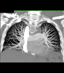 Nice 3D of SVC and Perfect Timing for A Pulmonary Embolism (PE) Study - CTisus CT Scan