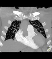 Nice 3D of SVC and Perfect Timing for A Pulmonary Embolism (PE) Study - CTisus CT Scan