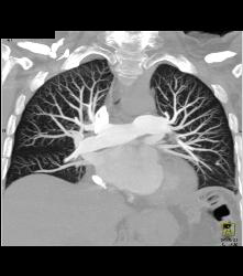 Nice 3D of SVC and Perfect Timing for A Pulmonary Embolism (PE) Study - CTisus CT Scan