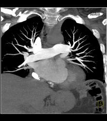 Nice 3D of SVC and Perfect Timing for A Pulmonary Embolism (PE) Study - CTisus CT Scan