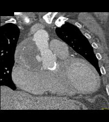 Pseudo-aneurysm Off Root - CTisus CT Scan