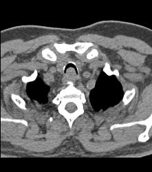 Primary Tracheal Tumor in 3D - CTisus CT Scan