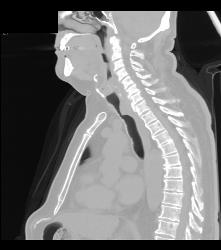 Primary Tracheal Tumor in 3D - CTisus CT Scan