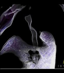 Primary Tracheal Tumor in 3D - CTisus CT Scan