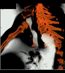 Primary Tracheal Tumor in 3D - CTisus CT Scan