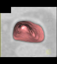 Primary Tracheal Tumor in 3D - CTisus CT Scan