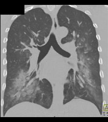 Pulmonary Hemorrhage - CTisus CT Scan