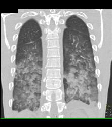 Pulmonary Hemorrhage - CTisus CT Scan