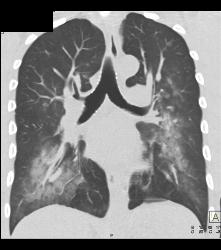 Pulmonary Hemorrhage - CTisus CT Scan