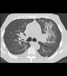 Pulmonary Hemorrhage - CTisus CT Scan