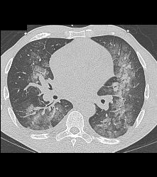 Pulmonary Hemorrhage - CTisus CT Scan