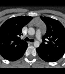 Thymic Hyperplasia - CTisus CT Scan