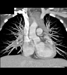 Thymic Hyperplasia - CTisus CT Scan