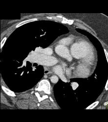 Pulmonary Artery Aneurysm - CTisus CT Scan