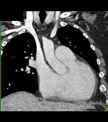 Pulmonary Artery Aneurysm - CTisus CT Scan