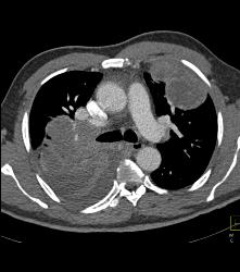 Metastatic Sarcoma Invades Left Atrium - CTisus CT Scan