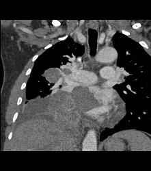 Metastatic Sarcoma Invades Left Atrium - CTisus CT Scan