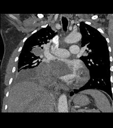 Metastatic Sarcoma Invades Left Atrium - CTisus CT Scan