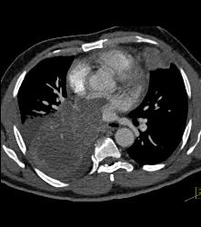 Metastatic Sarcoma Invades Left Atrium - CTisus CT Scan