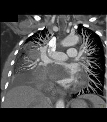 Metastatic Sarcoma Invades Left Atrium - CTisus CT Scan