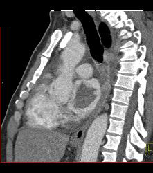 Metastatic Sarcoma Invades Left Atrium - CTisus CT Scan