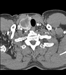 Thyroid Goiter - CTisus CT Scan