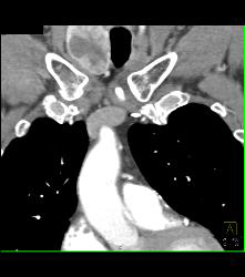 Thyroid Goiter - CTisus CT Scan