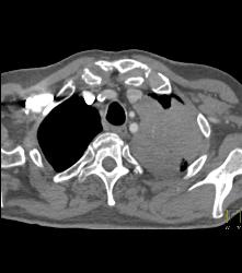 Lung Cancer Encases the Left Main Pulmonary Artery - CTisus CT Scan