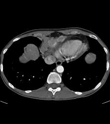 Paracardiac Nodes - CTisus CT Scan