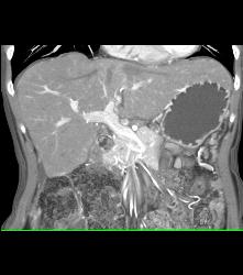 Paracardiac Nodes - CTisus CT Scan