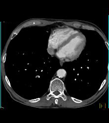 Pe- Right Lower Pulmonary Artery - CTisus CT Scan