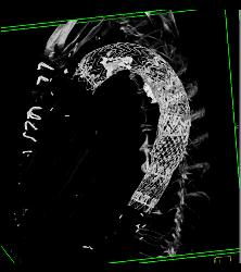 Endovascular Stent - CTisus CT Scan