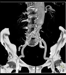 Endovascular Stent - CTisus CT Scan