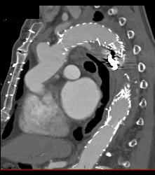 Endovascular Stent - CTisus CT Scan