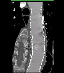 Endovascular Stent - CTisus CT Scan