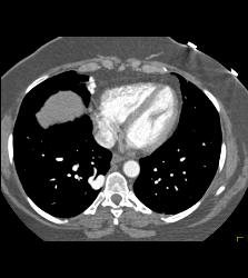 Pulmonary Arteriovenous Malformation (PAVM) in Multiple Projections - CTisus CT Scan